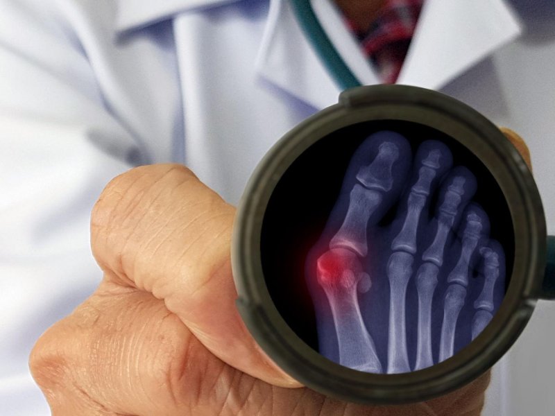 Bunion Surgery