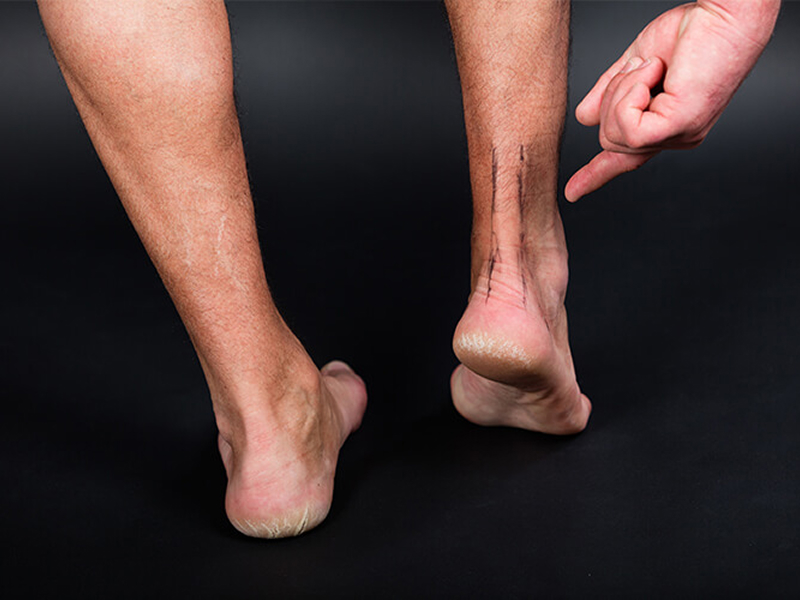 Achilles Repair