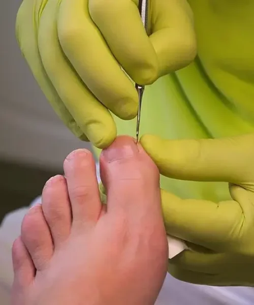 imgi_33_ingrowntoenails_img